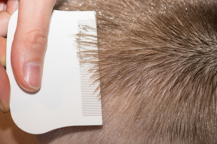 Lice 101: What They Are + How to Remove Them